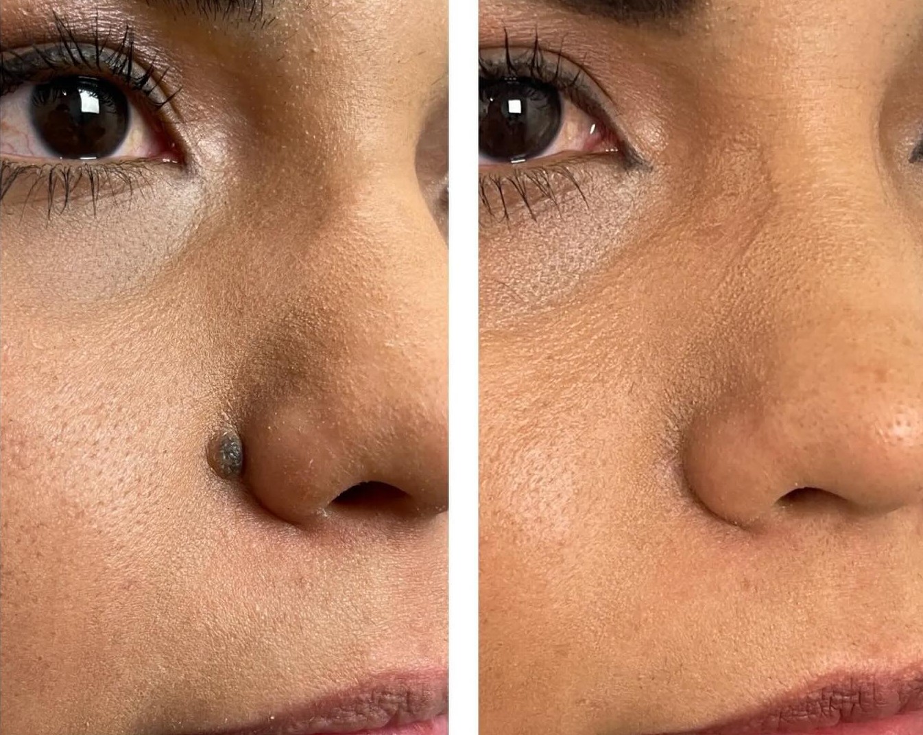 Skin and Face PHX Facebook ad: ¿Aún estás pensando en eliminar ese lunar o…