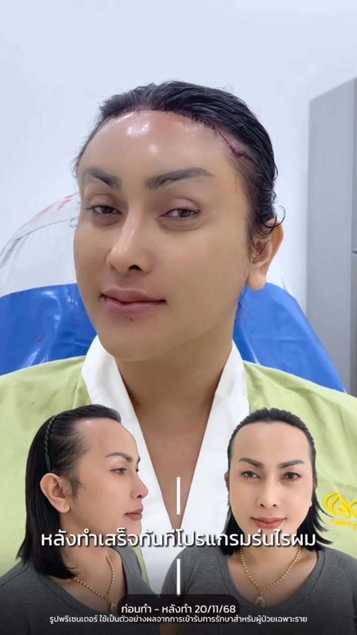 Century Health Clinic Facebook ad: โปรแกรมร่นไรผม