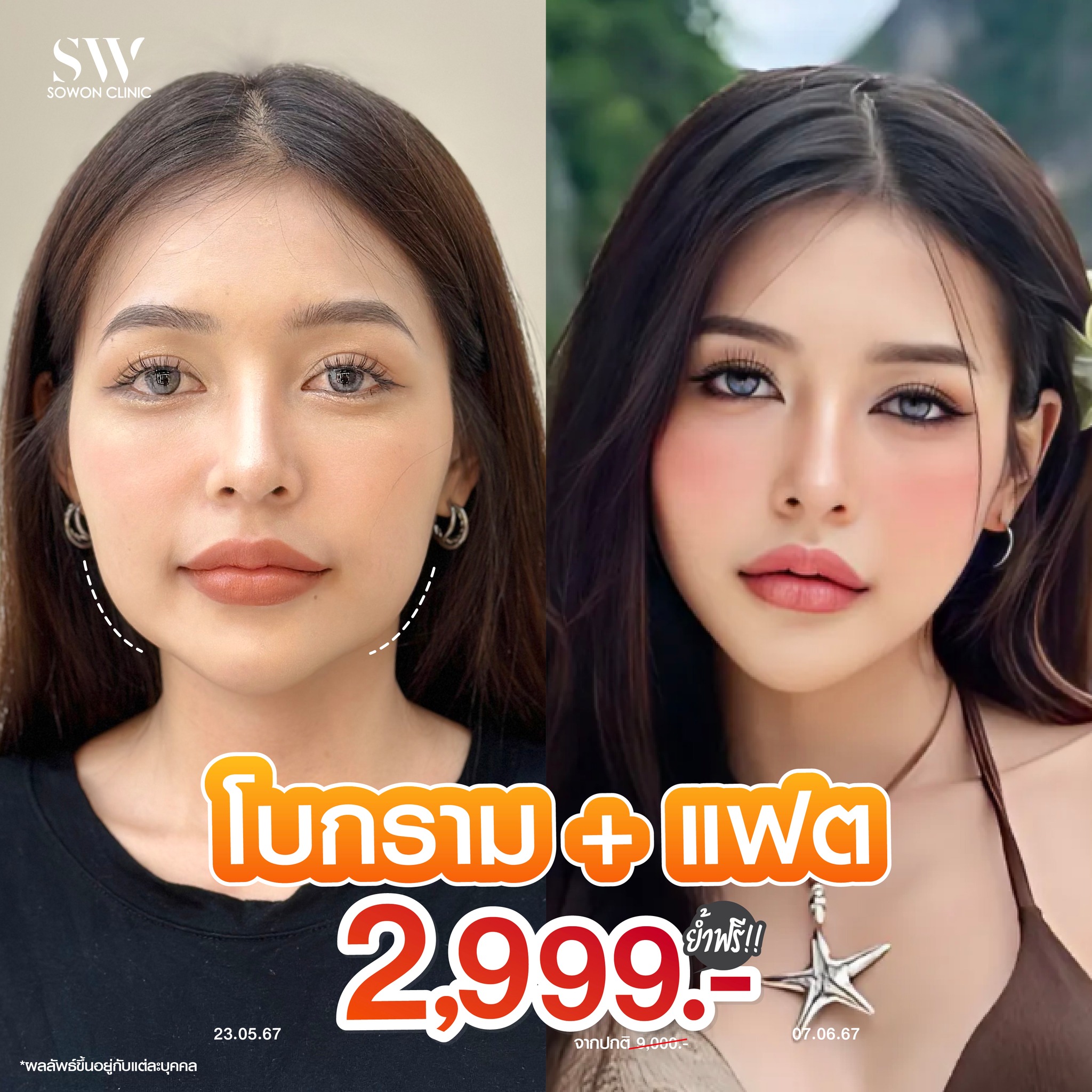 Sowon clinic Botox Filler HIFU ร้อยไหม โบท็อกซ์ ฟิลเลอร์ ปรับรูปหน้า Facebook ad