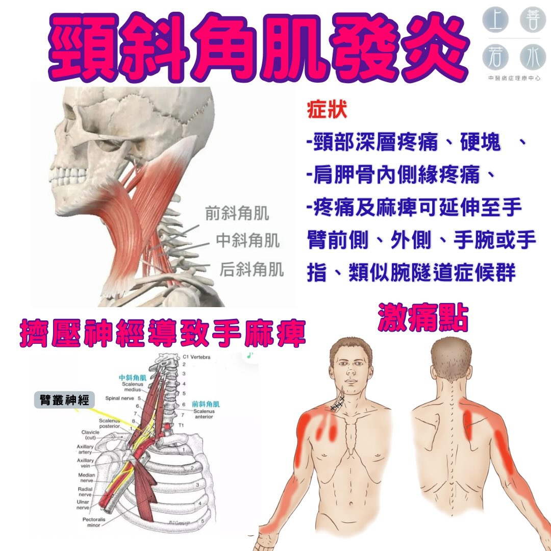 上善若水中醫痛症理療中心 Mercy Chinese Medicine Clinic 筋膜痛症 Chronic Pain Treatment Facebook ad