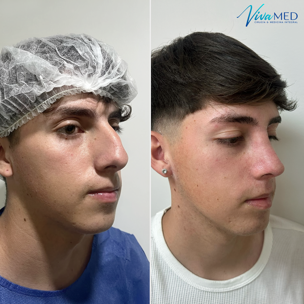 Vivamed.CL Facebook ad: Rinoplastia Ultrasónica