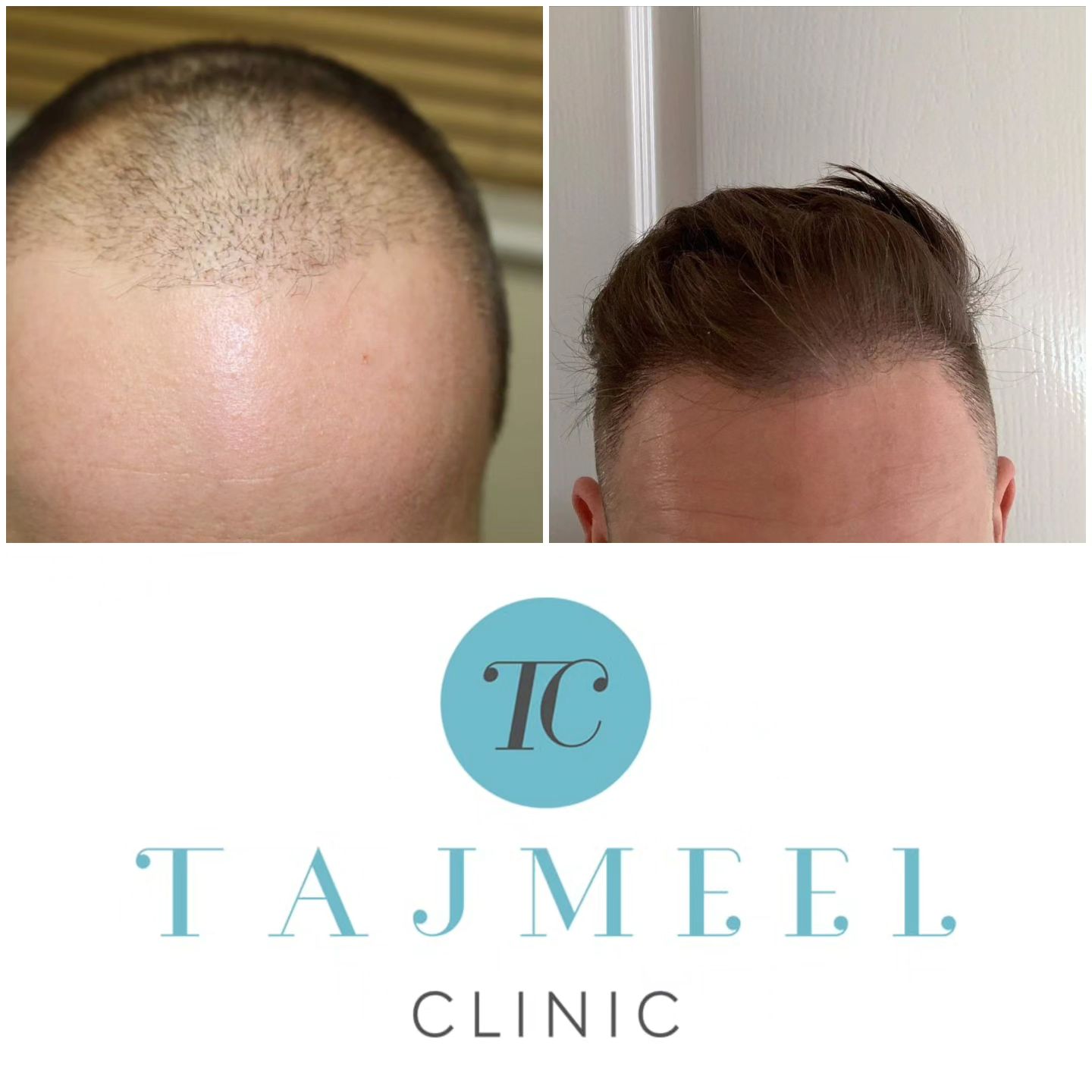 Tajmeel Clinic Facebook ad: Hair Transplant, hair loss treatment, Scalp…