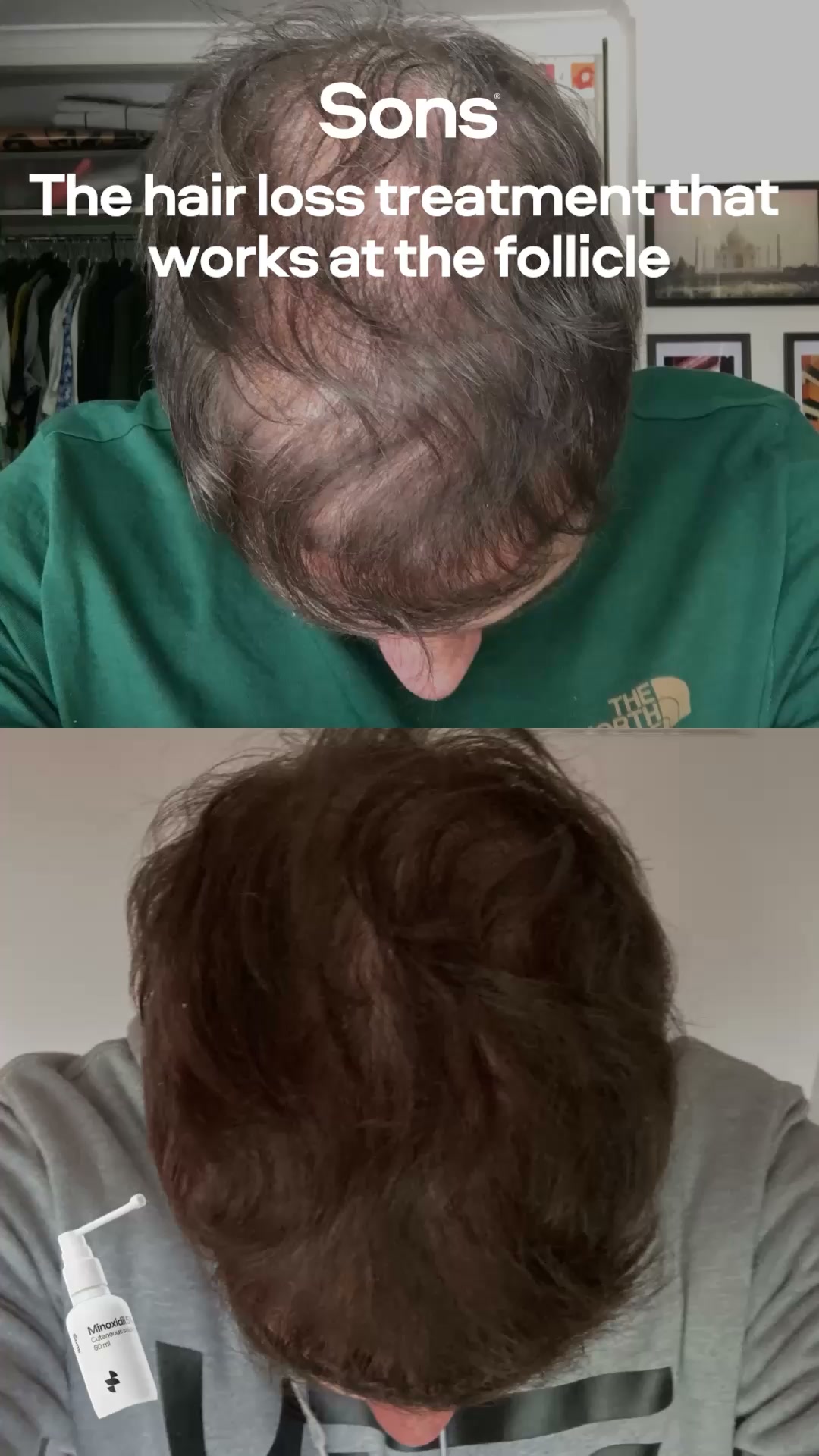 Sons Facebook ad: Your hairline. Your call.