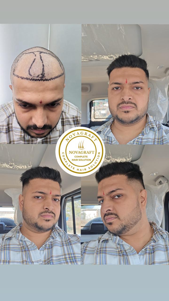 Zyra Aesthetics Facebook ad: Hair transplant in Delhi