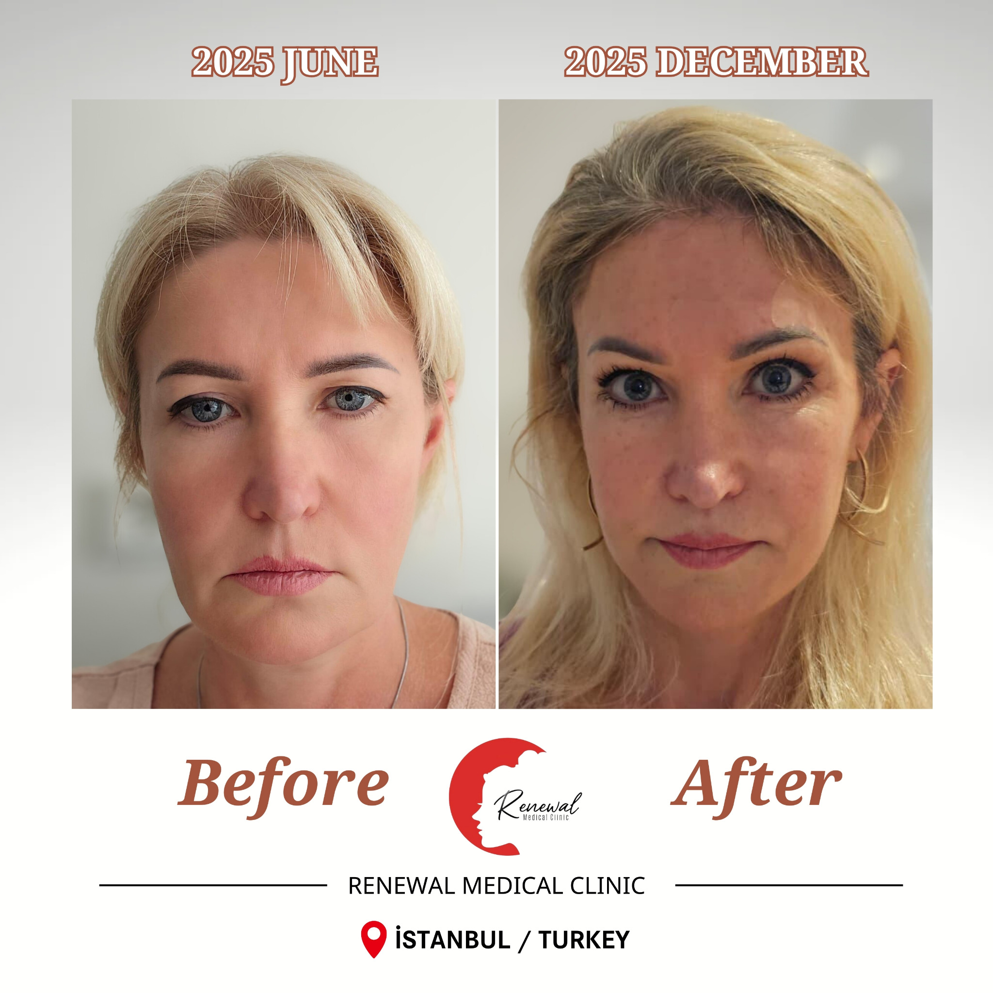 Renewal Clinic Turkey Facebook ad from Jun 11, 2026