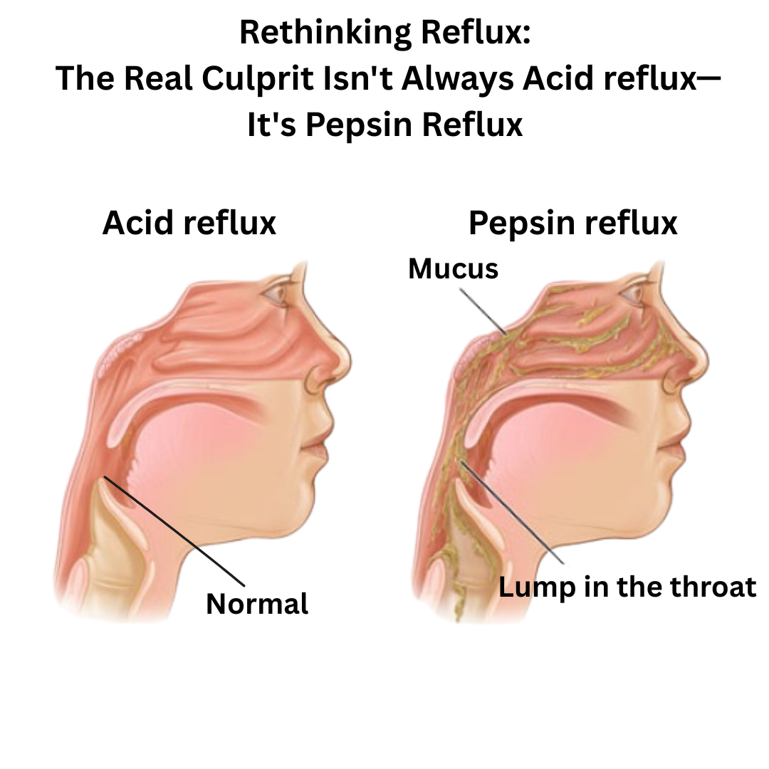 The Reflux Report Facebook ad