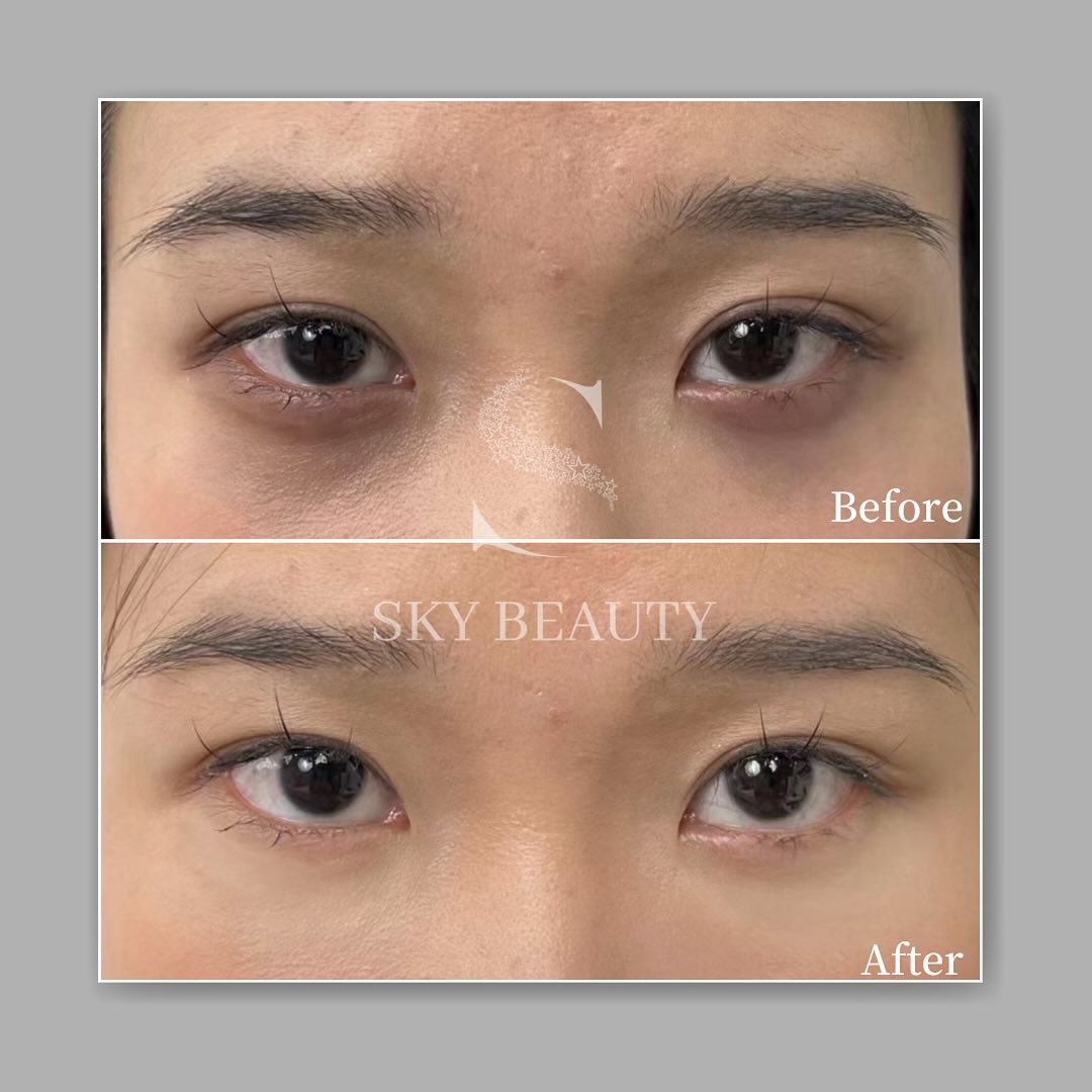 Sky Beauty Cosmetic Clinic 星辰美學健康管理中心 Facebook ad: Fotona Eye Treatment: The Difference Is Clear!