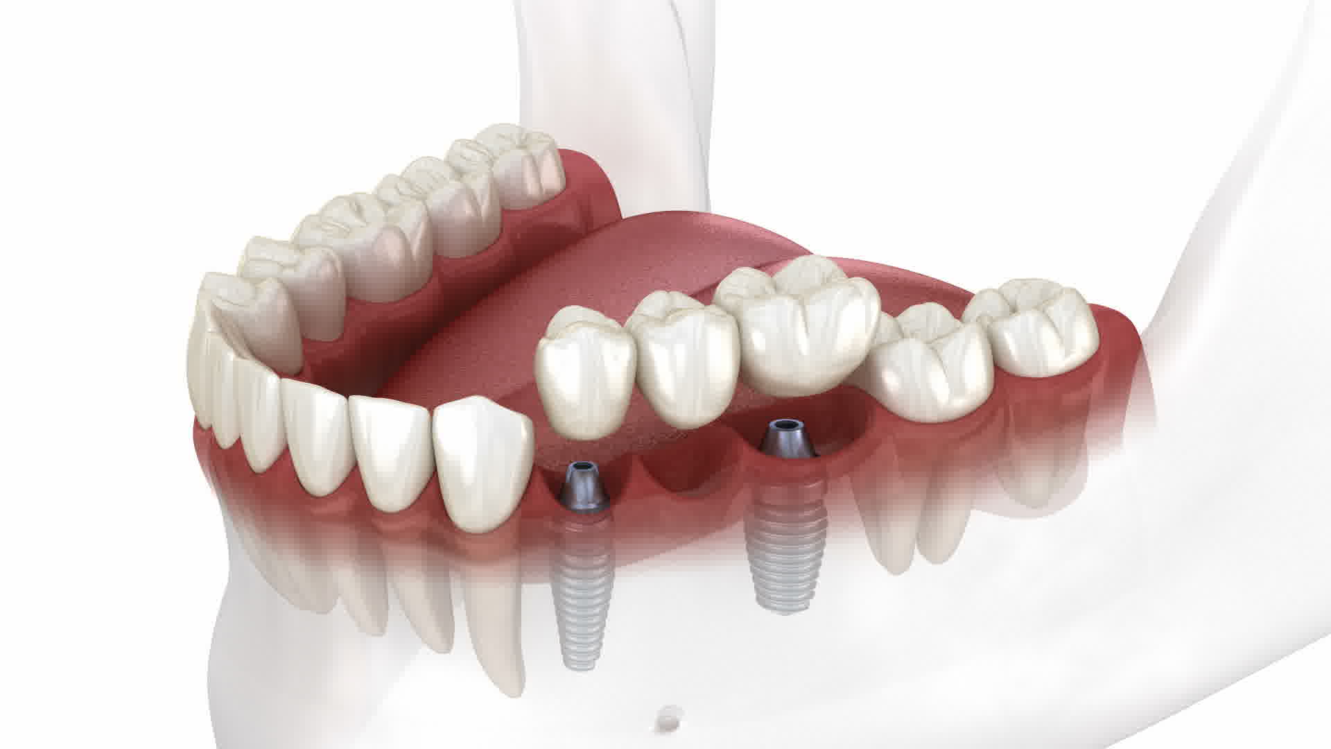 Purple Dental Facebook ad: Transform Your Smile with Dental Implants Starting at…