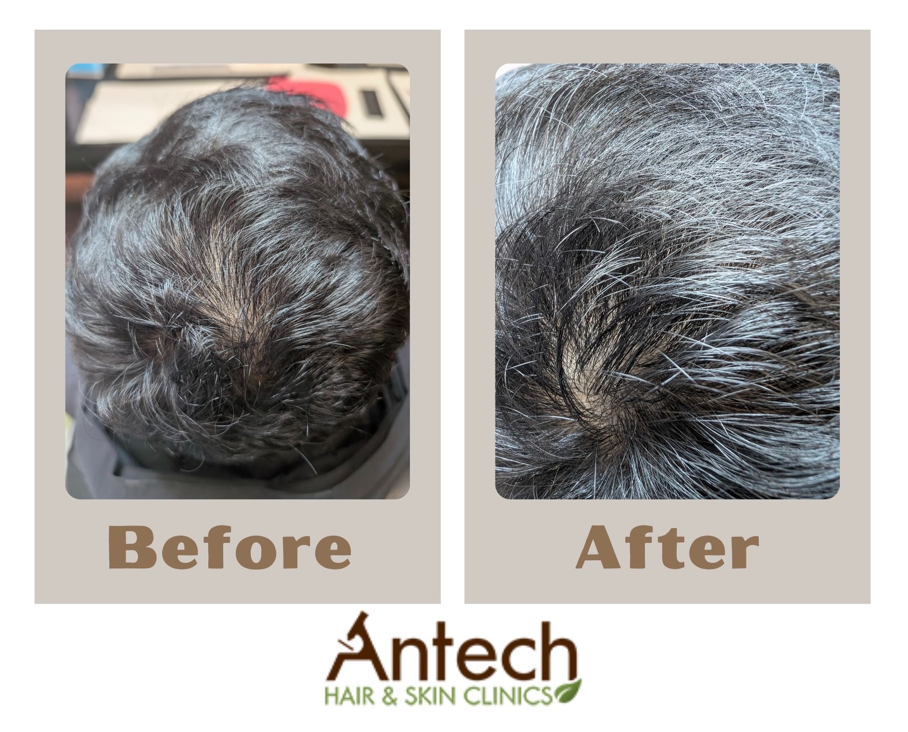 Antech Hair & Skin Clinic Facebook ad