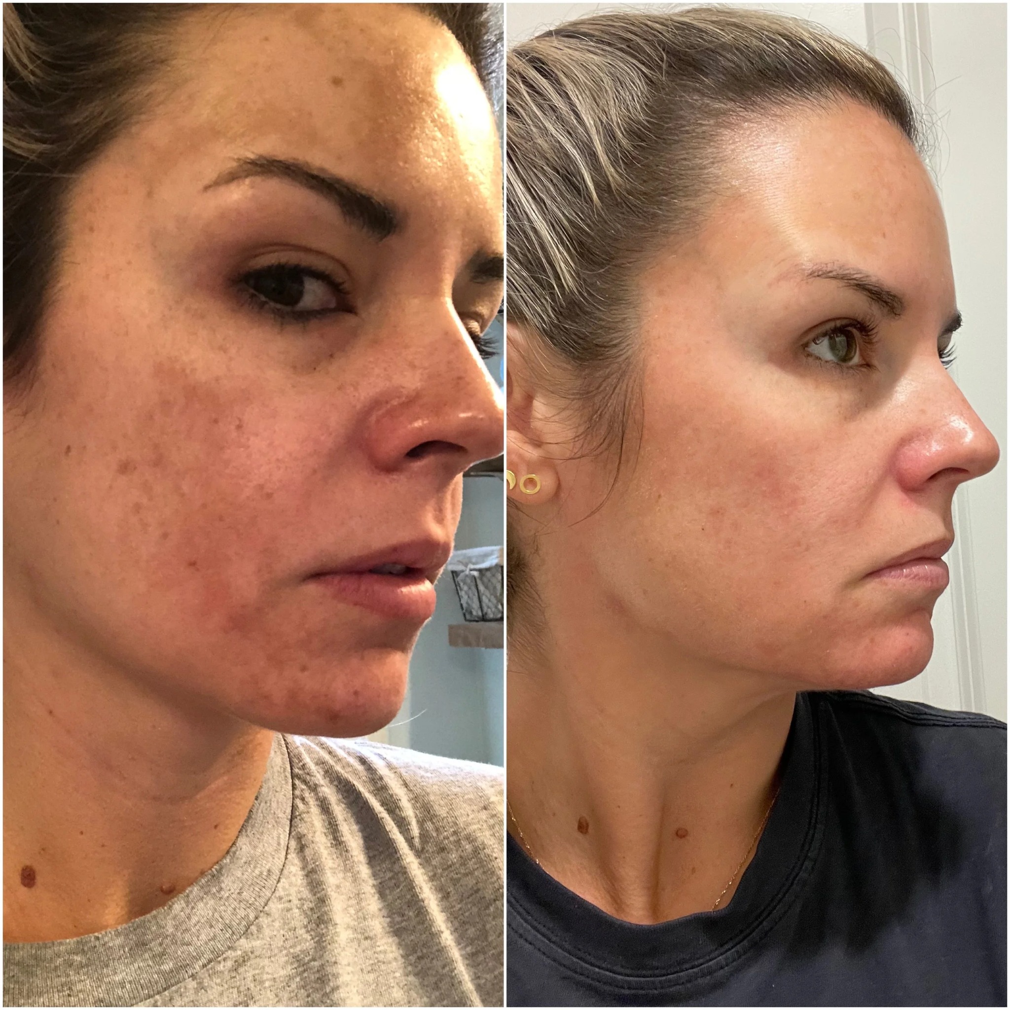 Rachel Malone Facebook ad: Struggling with Hyperpigmentation? Read this.