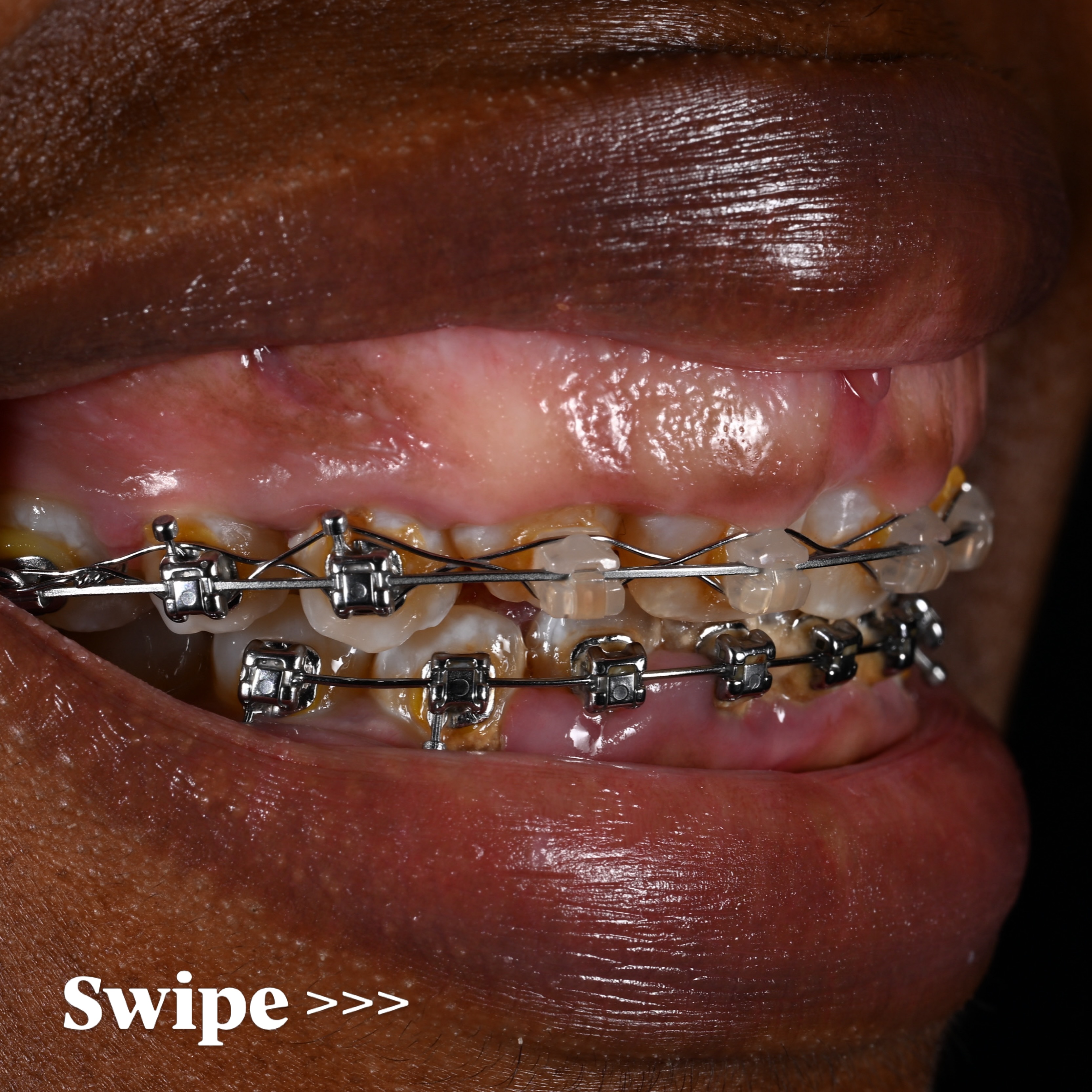 Dr Toro Smile Design Facebook ad: Swipe to the left to see the final…
