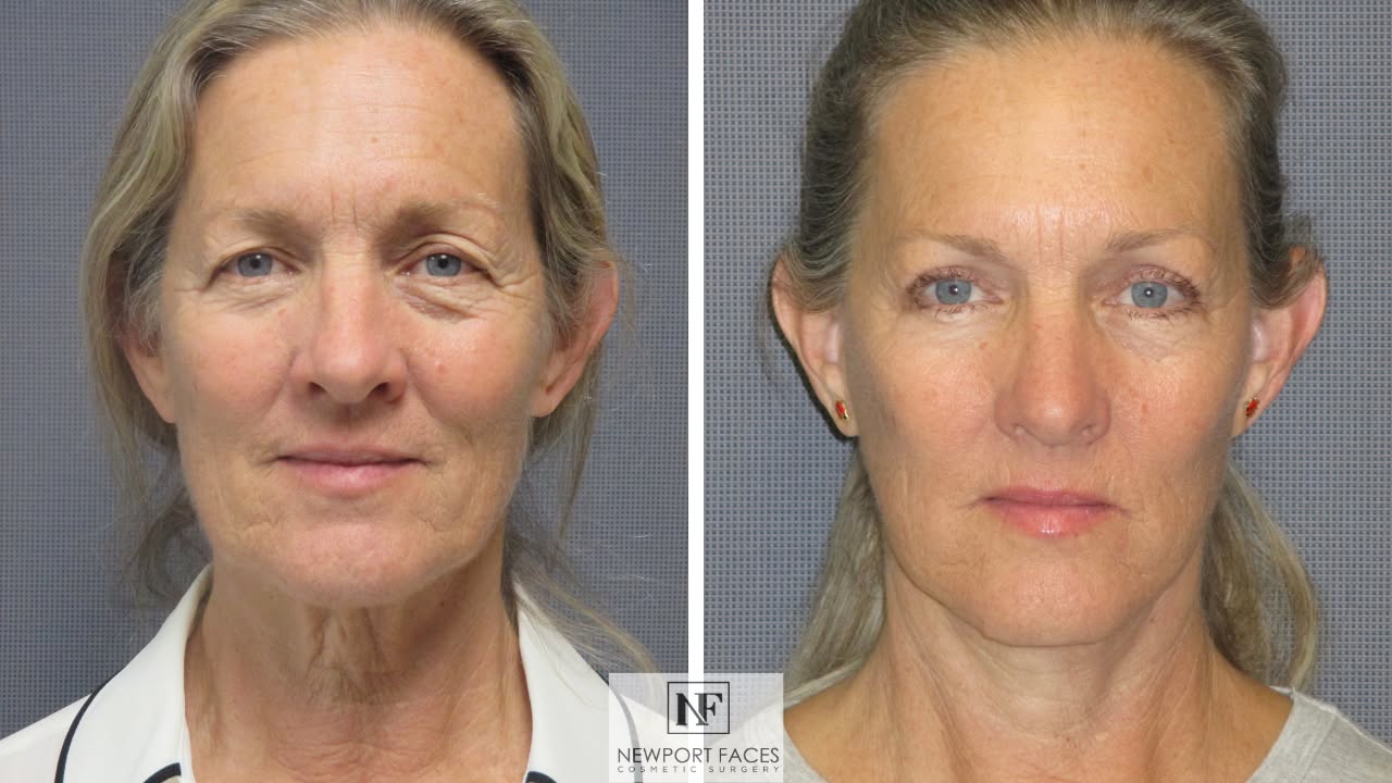 Dr. Stephen Fink - Newport Faces Cosmetic Surgery Facebook ad