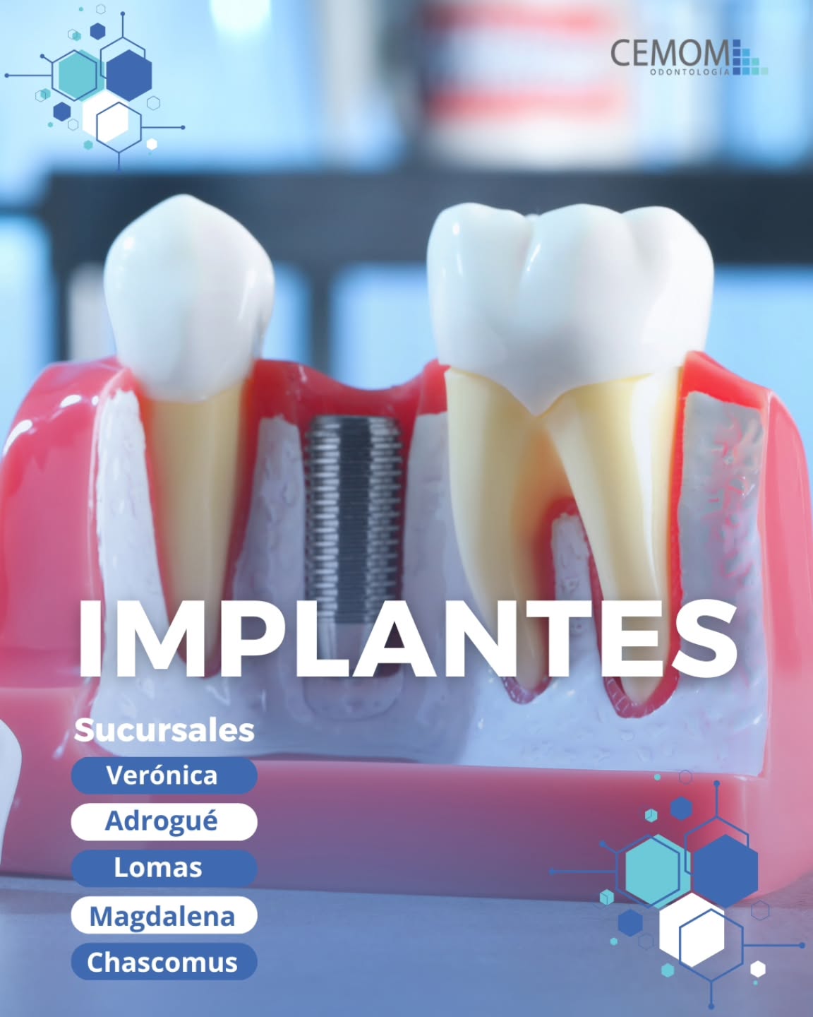 CEMOM Odontología Facebook ad: Implantes Dentales