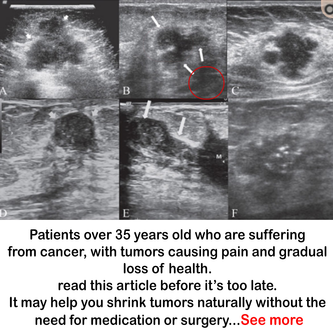 Dr. Adel Elemia Facebook ad: Home cancer treatment method