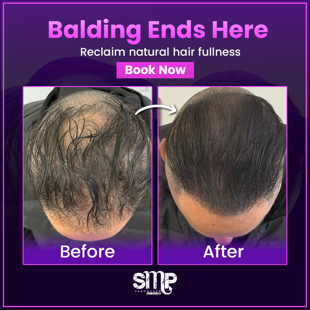 SMP Vancouver- Luis Enrique Facebook ad: Vancouver, 15% Off Scalp Micropigmentation