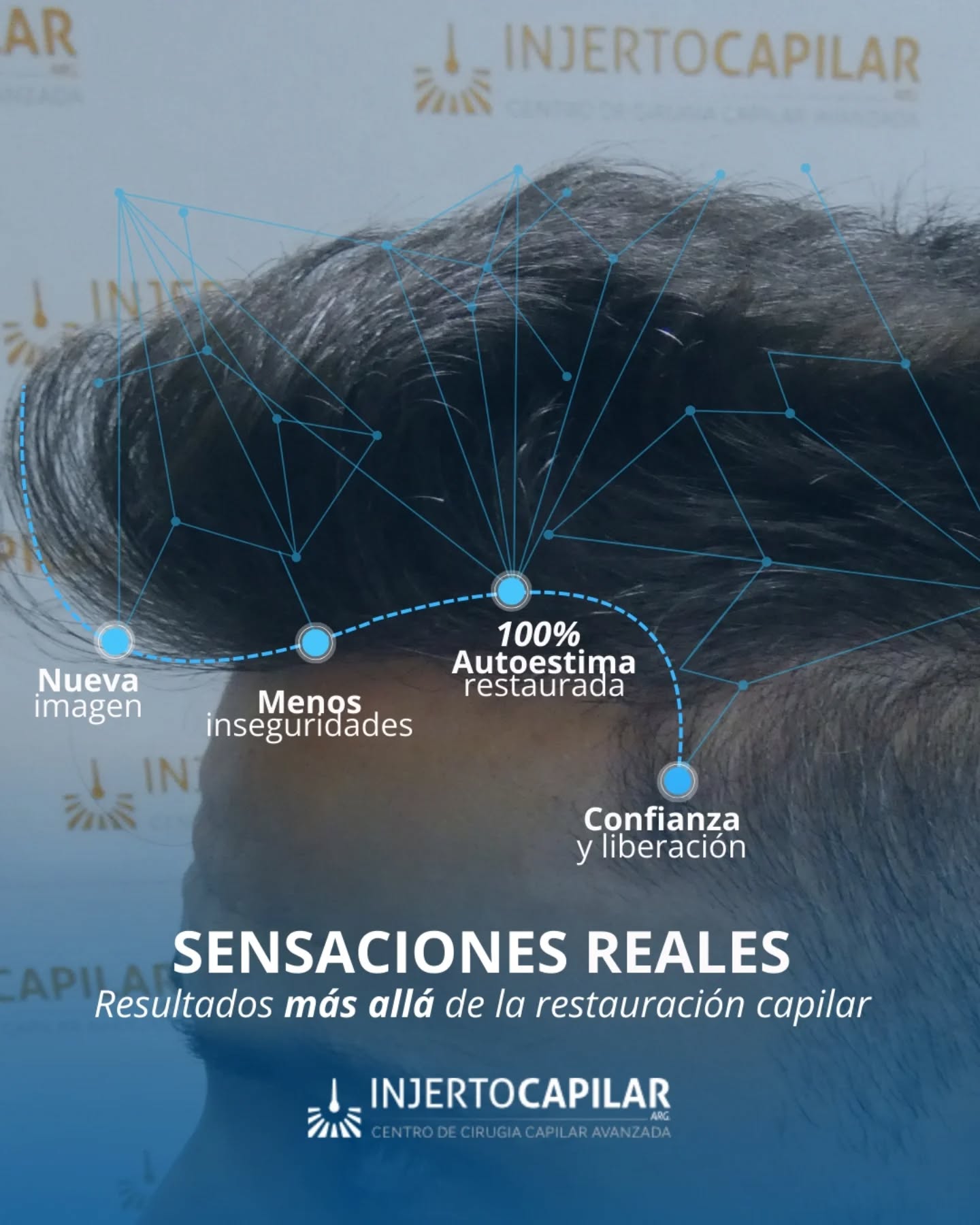 Injerto Capilar Argentina Facebook ad: En Injerto Capilar recuperamos algo más que tu…