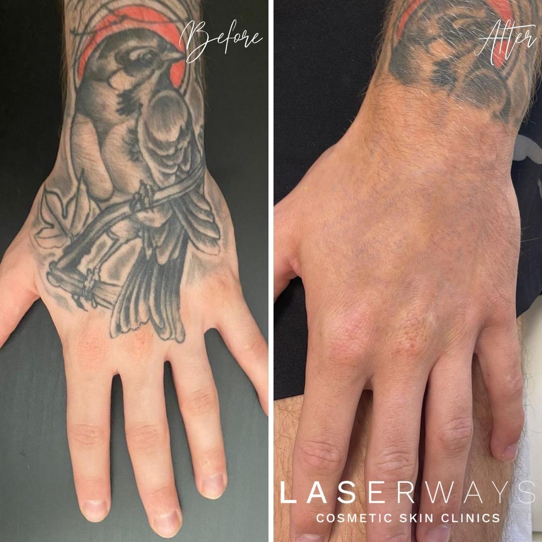 Laserways Facebook ad: AWARD WINNING TATTOO REMOVAL