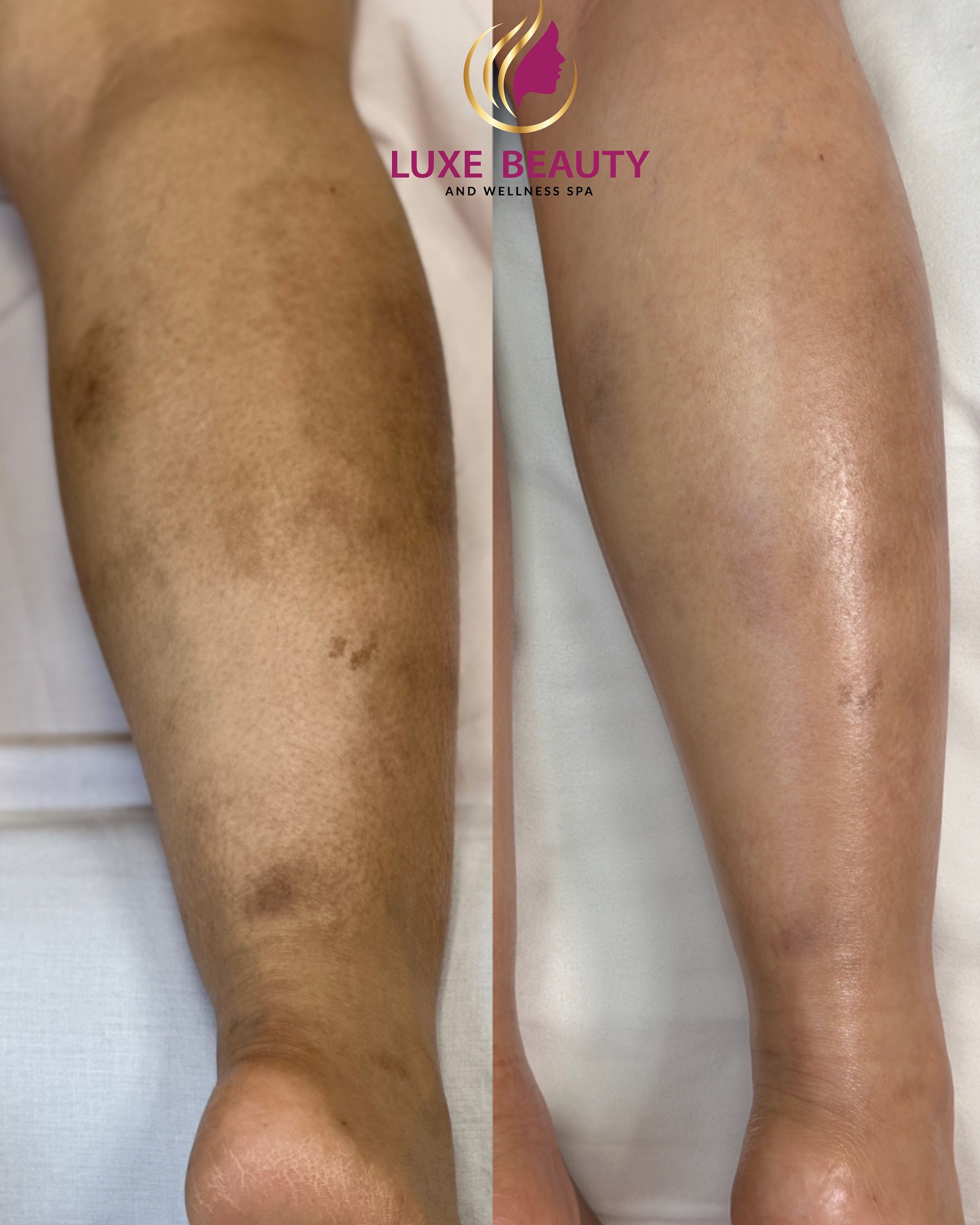 Luxe Beauty and Wellness Spa in Mississauga Facebook ad: 10 YEARS OF HYPERPIGMENTATION.