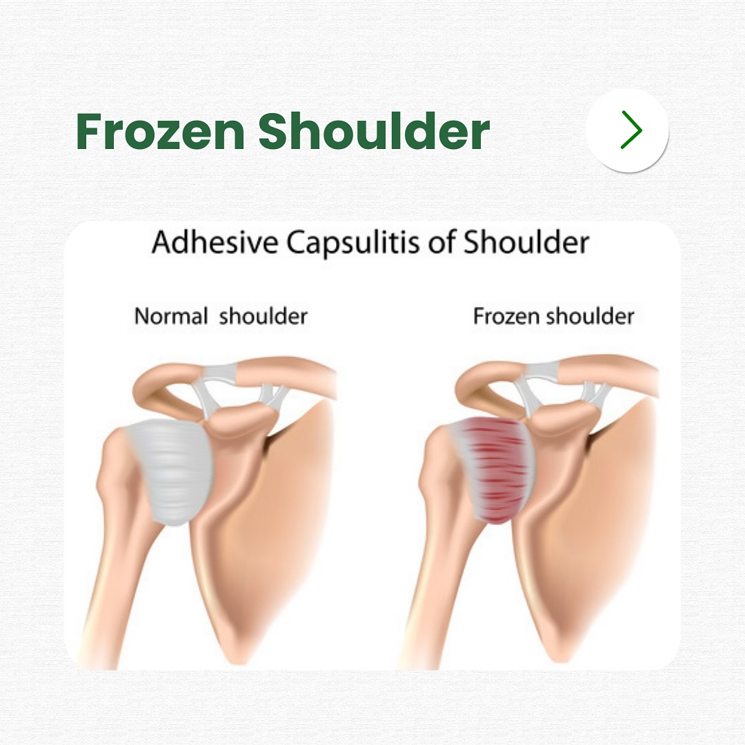 Orchard Health Clinic Facebook ad: Did you know - Frozen Shoulder is a…