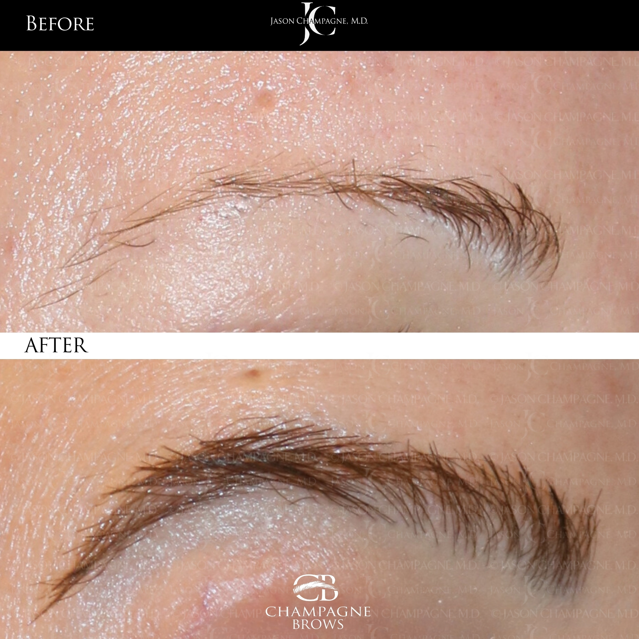 Jason Champagne, M.D. Facebook ad: Timeless, Fuller Brows