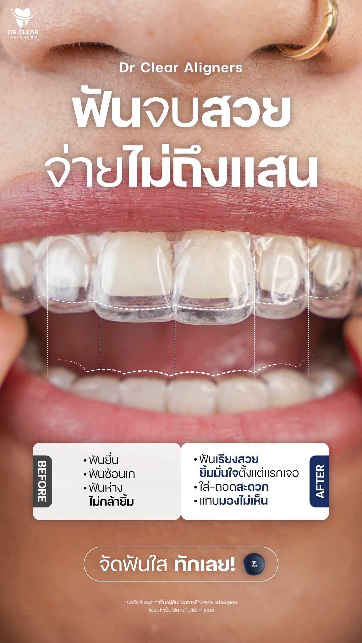 Dr Clear Aligners Thailand Facebook ad
