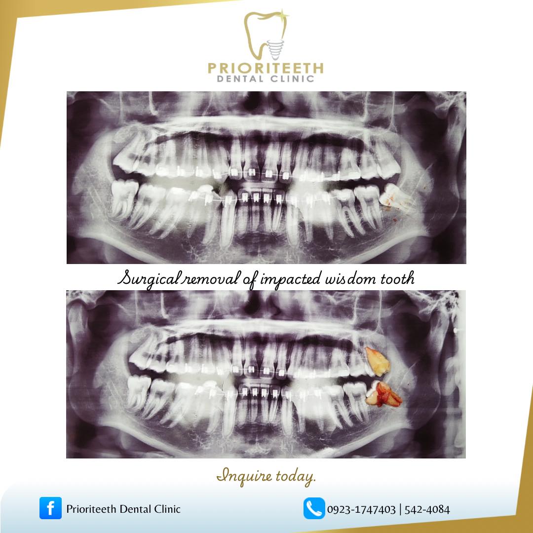 Prioriteeth Dental Clinic Facebook ad: May impacted wisdom tooth ka ba?