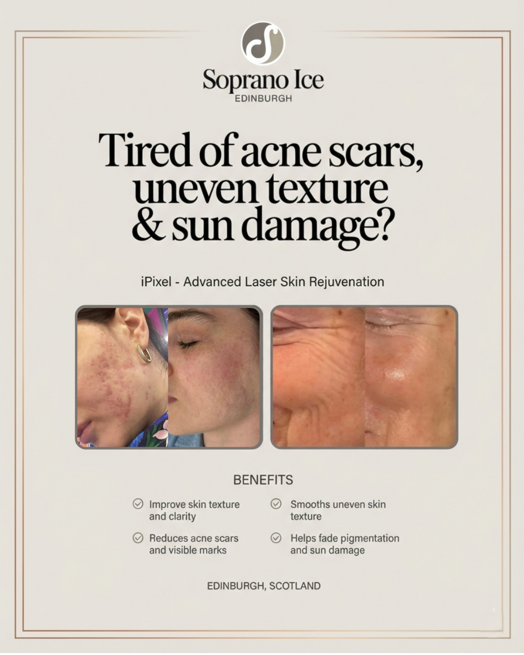 Soprano ICE Edinburgh Facebook ad: Up to 30% OFF Advanced Laser Skin Renewal