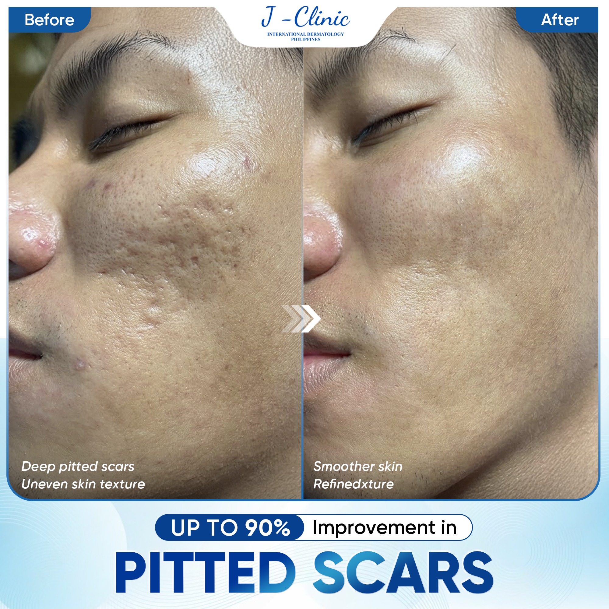 International Dermatology J Clinic Facebook ad: PITTED SCARS, THE LONGER YOU WAIT, THE HARDER…