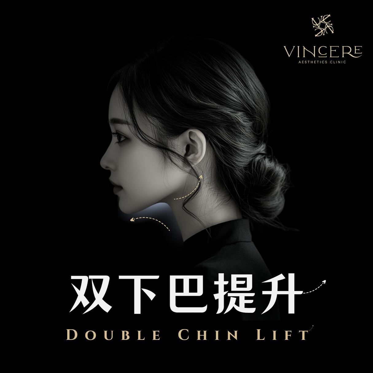 Vincere Aesthetics Clinic Facebook ad: 双下巴提升术是一种专门为优化下颌线条设计的非手术轮廓塑造疗法。这项治疗综合了减脂、紧肤和轮廓重塑的优势,能够改善因年龄…