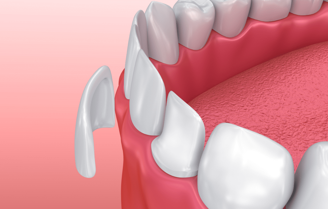 Dentatur Dental Health Clinics Facebook ad: Veneers in Turkey