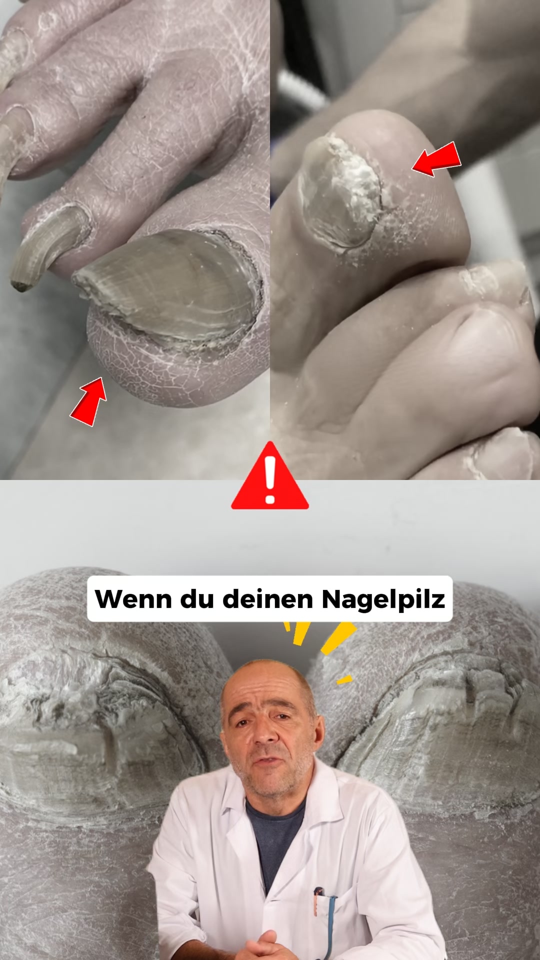 Nagelpilz Ratgeber Facebook ad: Der größte Fehler bei Nagelpilz