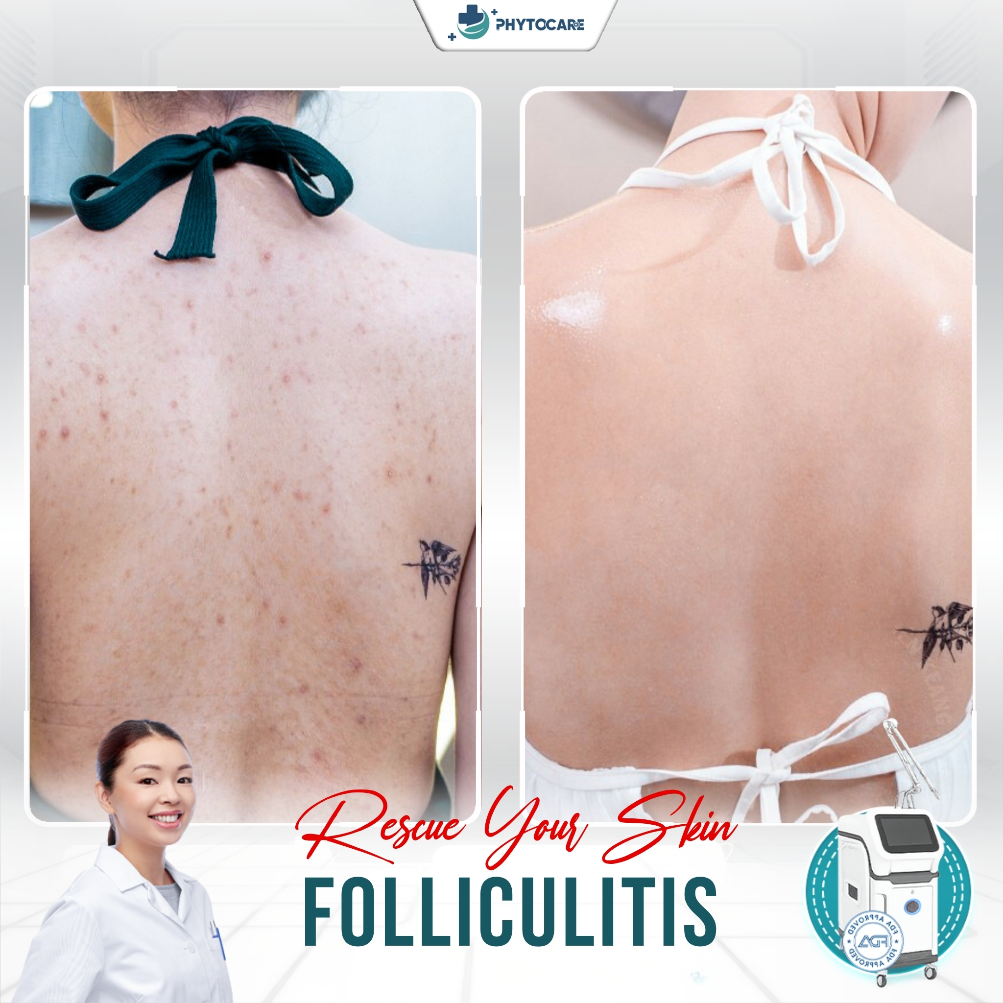 Phytocare DermaFolli Clinic Davao Facebook ad: Say Goodbye to Folliculitis - Rescue Your Skin!