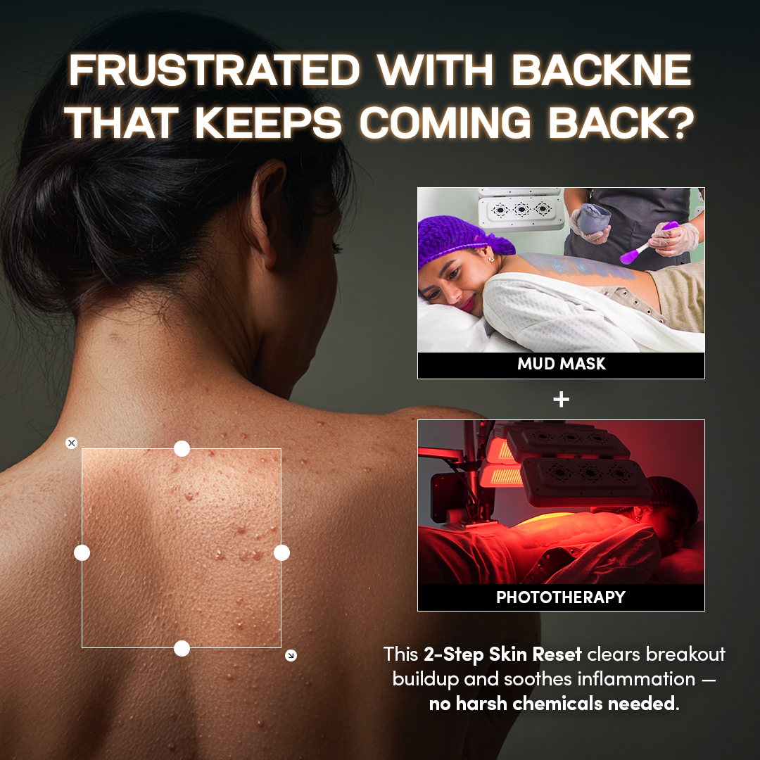 Emanuelle Beauty Facebook ad: P499 Only! | Bye Bye Back Acne