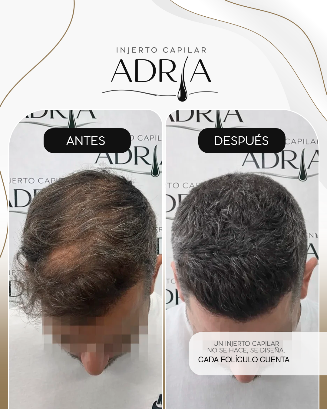 Injerto Capilar Adria Facebook ad