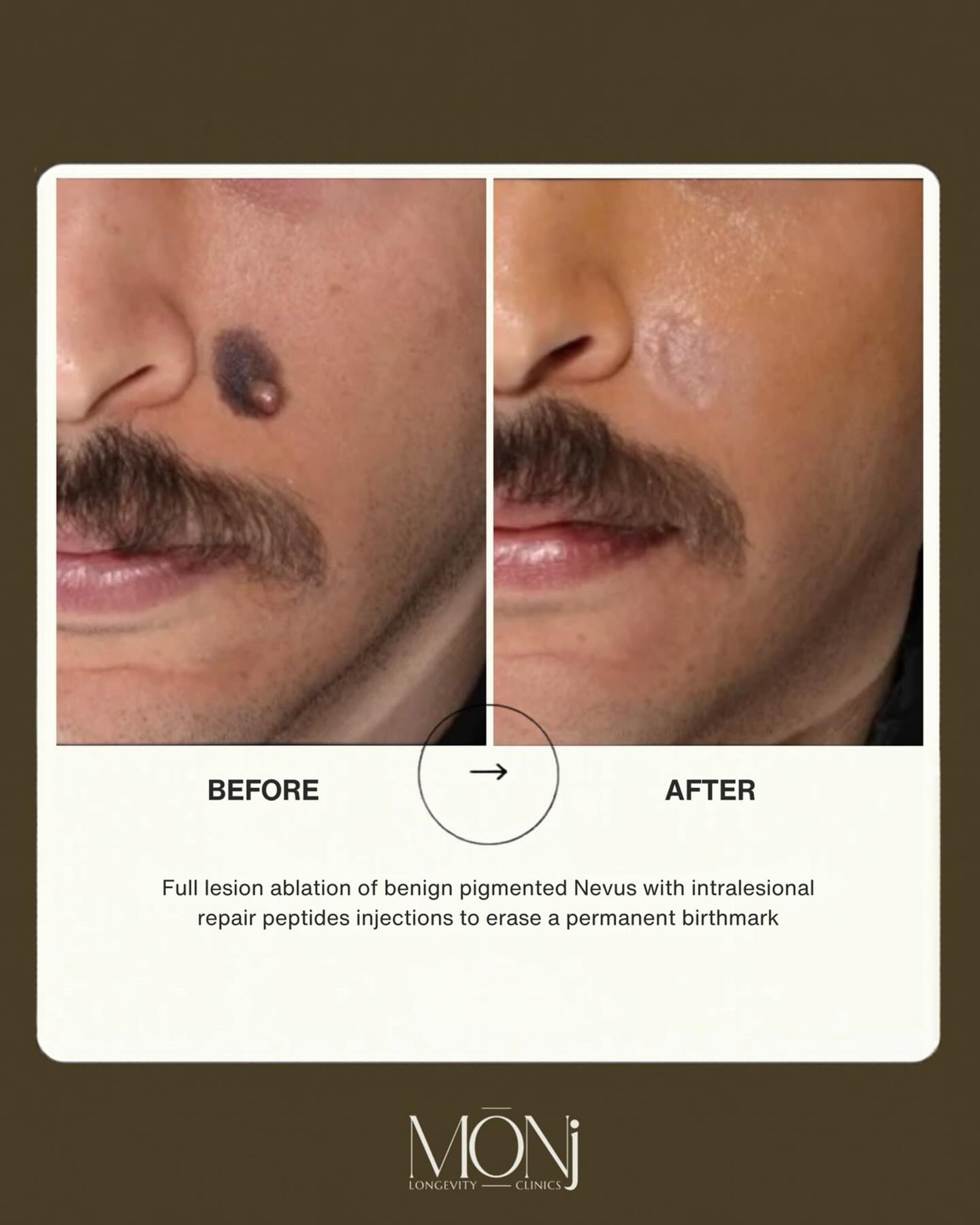 MōNj Longevity Clinics Facebook ad: Targeted lesion removal using advanced techniques and…