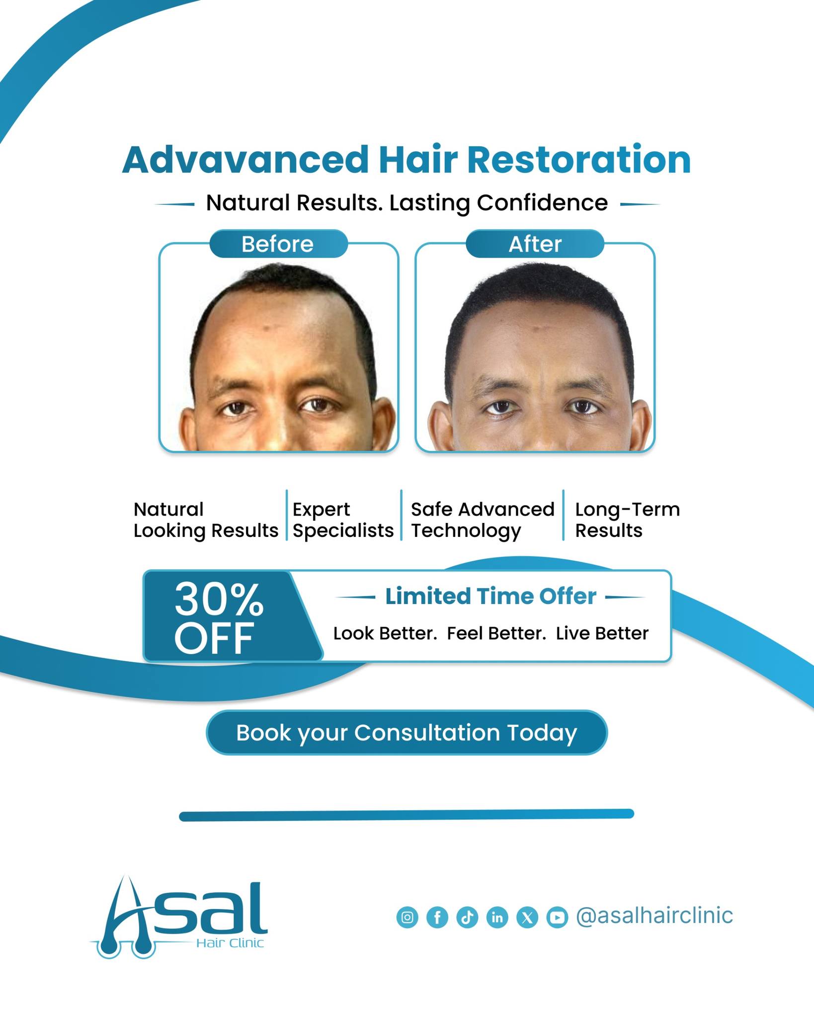 Asal Hair Clinic Facebook ad: 30% OFF FUE Hair Transplant Limited Time