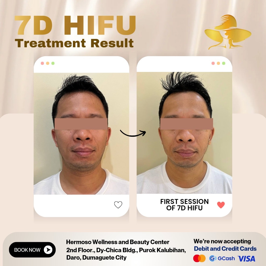Hermoso Wellness and Beauty Center Facebook ad: 𝗡𝗼 𝗳𝗶𝗹𝘁𝗲𝗿𝘀-𝘀𝗲𝗲 𝘁𝗵𝗲 𝗰𝗵𝗮𝗻𝗴𝗲 𝗮𝗳𝘁𝗲𝗿…