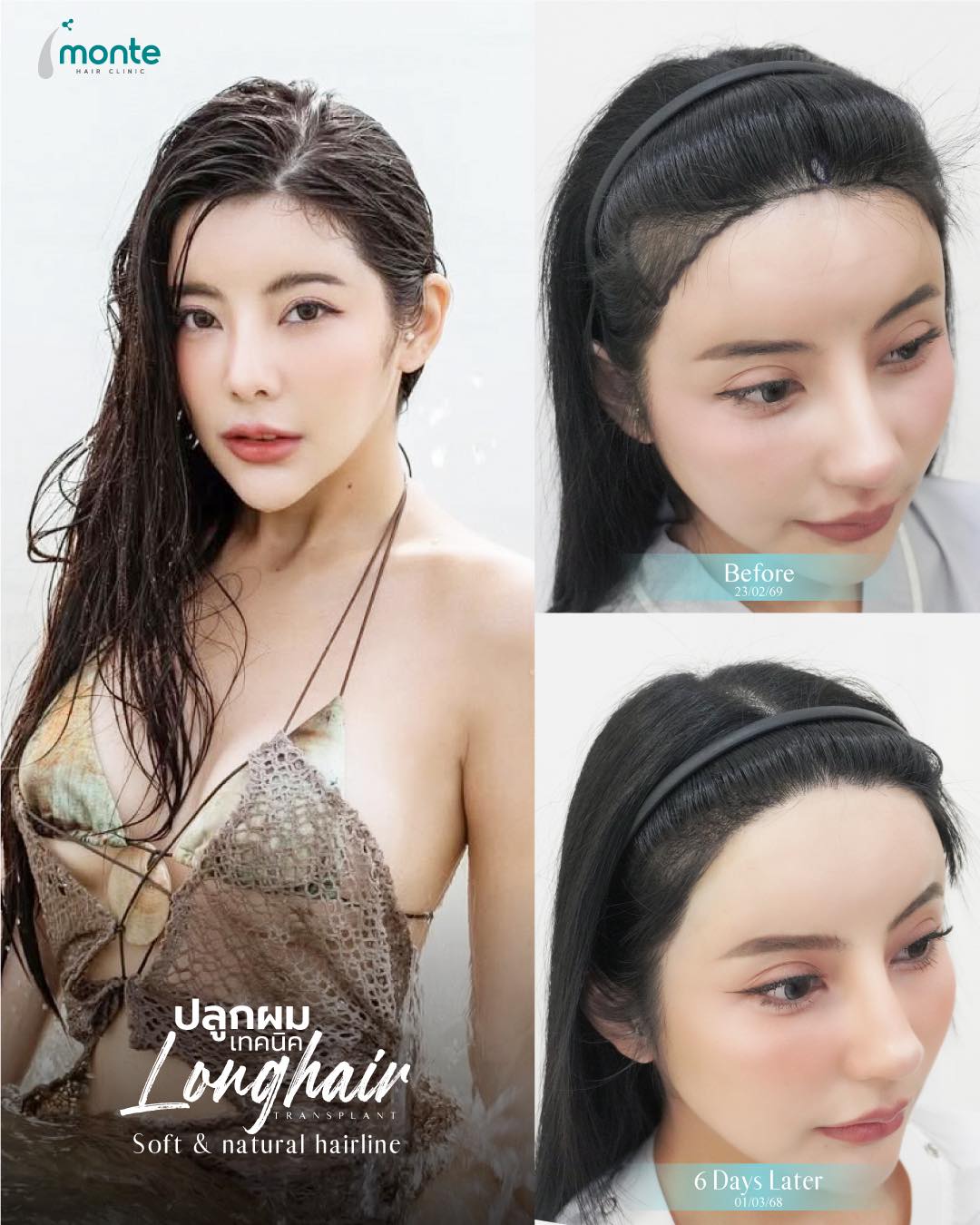 Monte Clinic - Hair Transplant ปลูกผมถาวร คิ้ว หนวดเครา รักษาผมบาง Facebook ad
