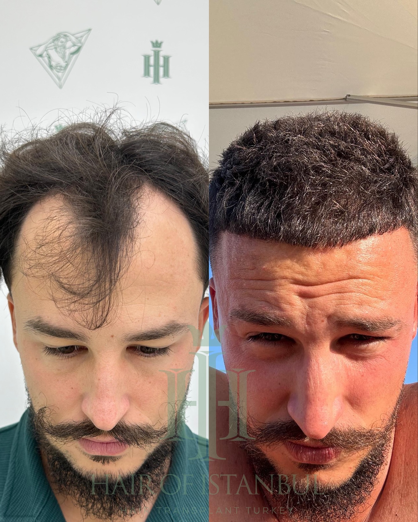 Hair of İstanbul Facebook ad