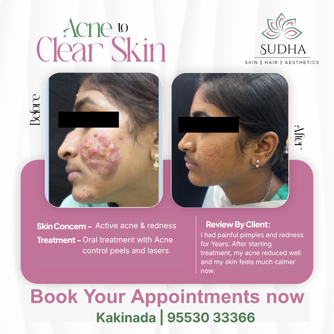 Sudha Skin Facebook ad: Struggling with Acne?