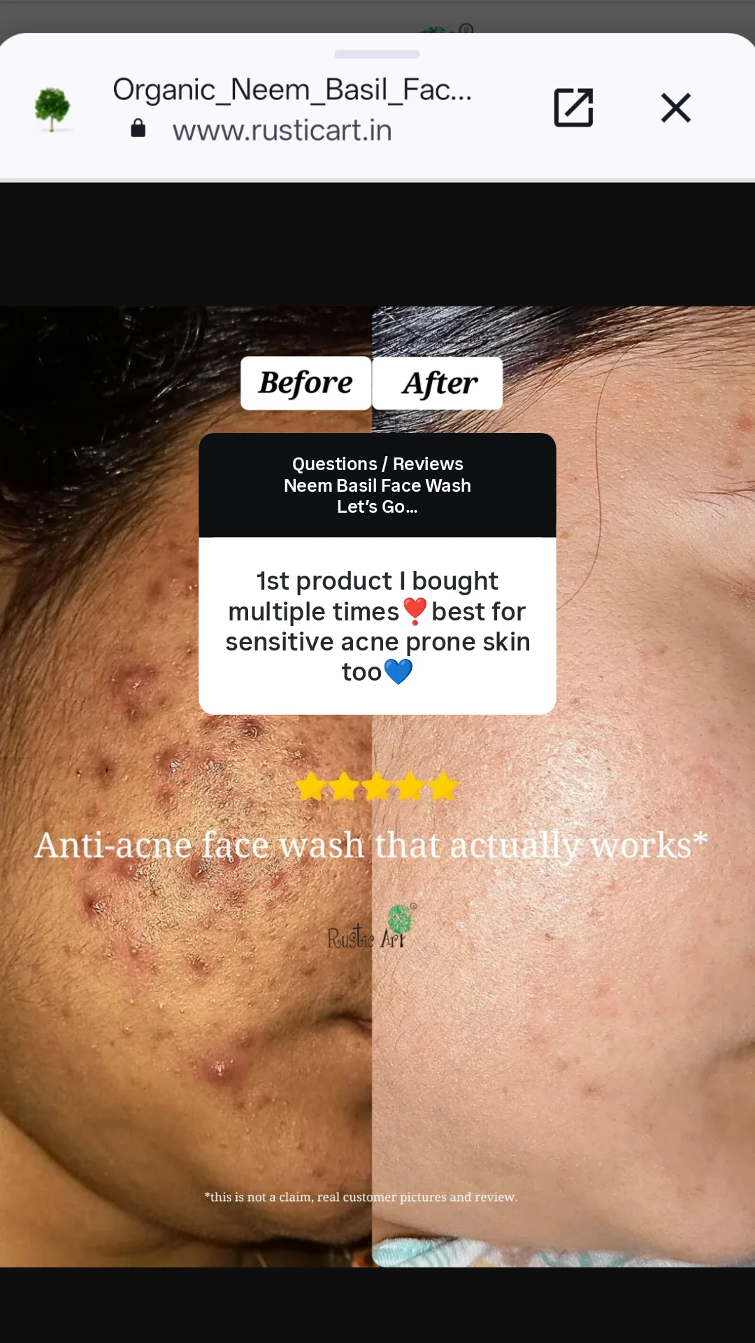 Rustic Art Facebook ad: Acne & Pigmentation Care Products - Natural Solutions |…