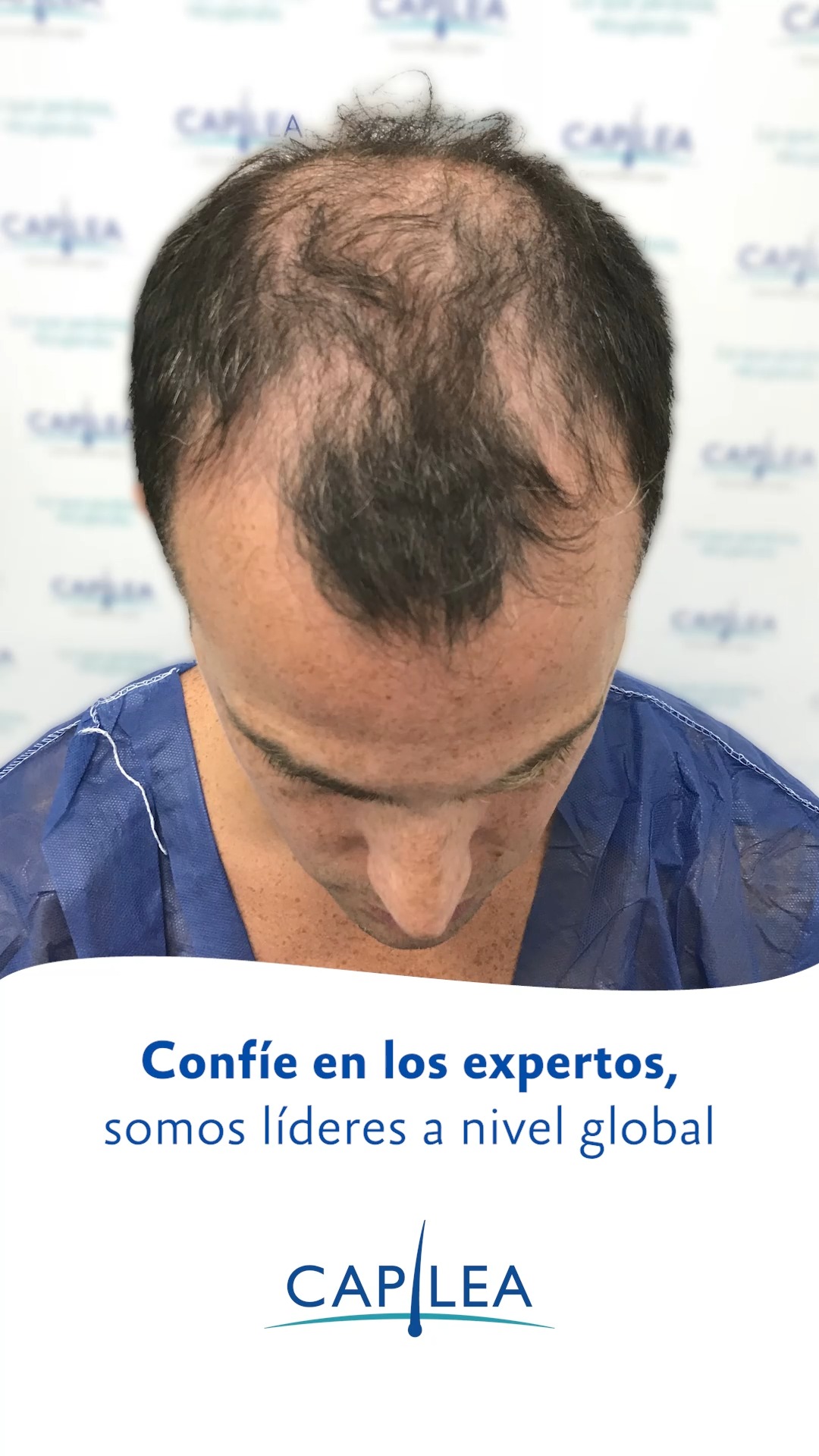 Capilea El Salvador Facebook ad: Rejuvenezca su apariencia reduciendo la línea frontal de…