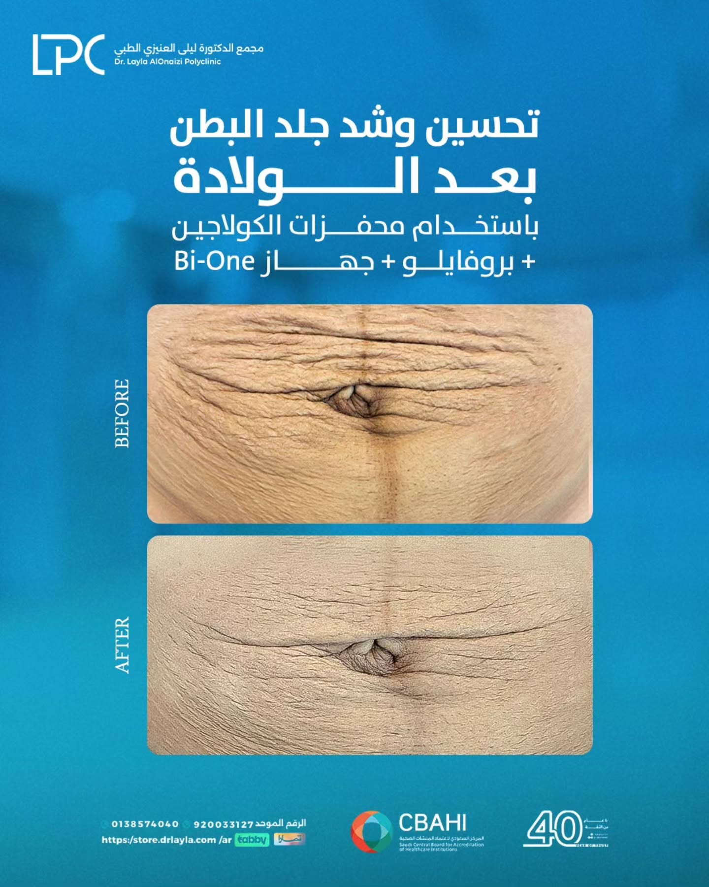 عيادات د. ليلى العنيزي الطبية LPC Clinics Facebook ad: حالة تحسين وشد جلد البطن بعد الولادة باستخدام…