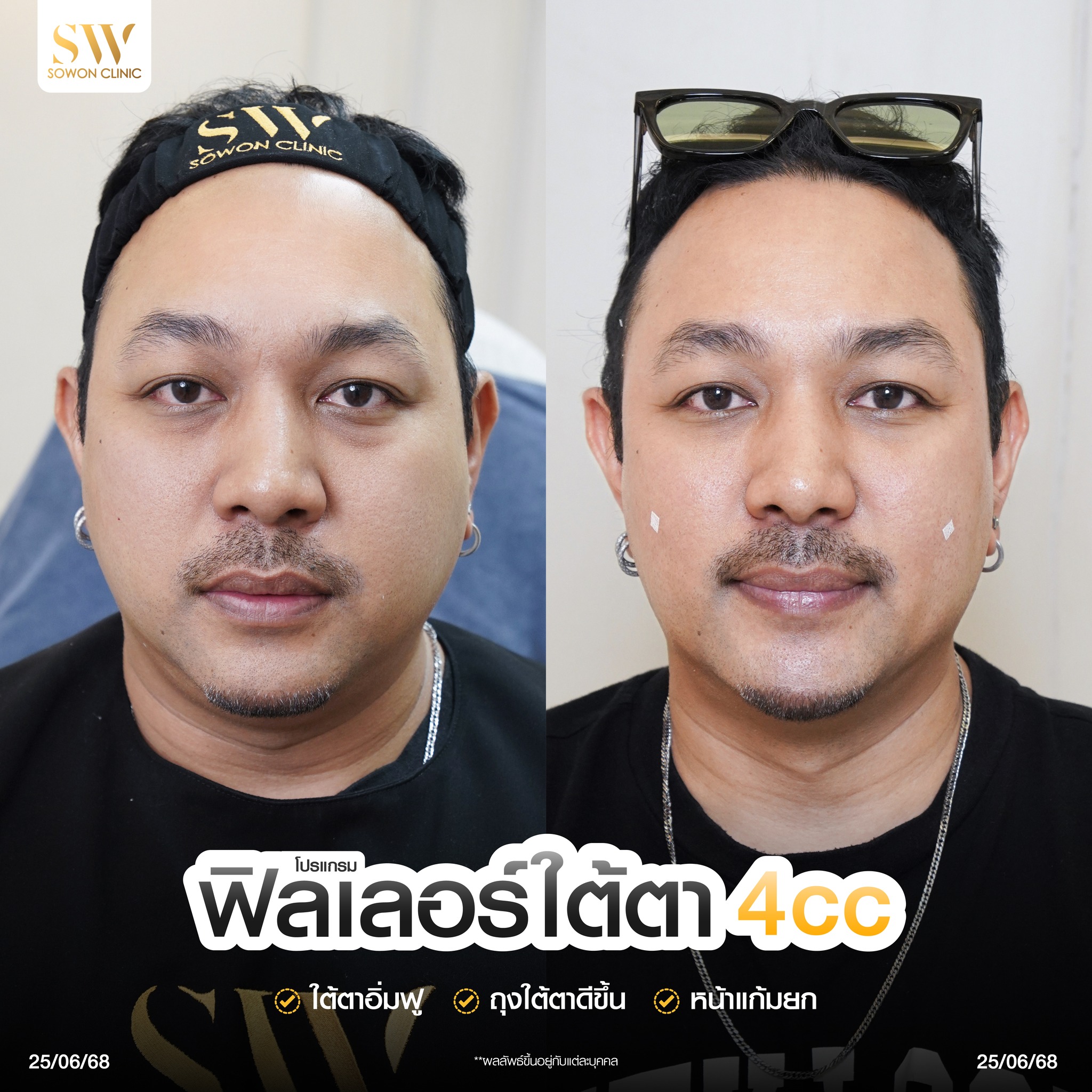 Sowon clinic Botox Filler HIFU ร้อยไหม โบท็อกซ์ ฟิลเลอร์ ปรับรูปหน้า Facebook ad
