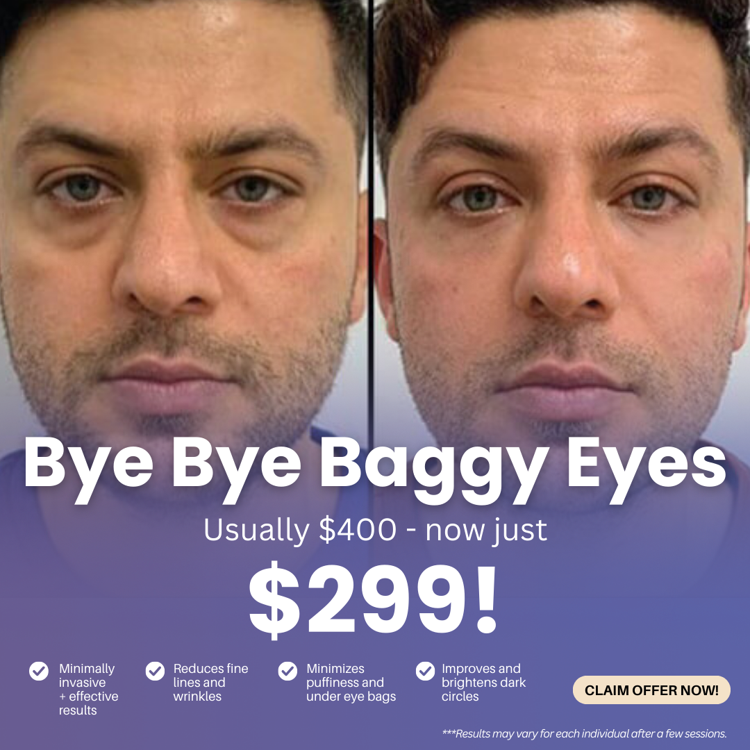 Skyy Med Spa Facebook ad: Bye Bye Baggy Eyes for ONLY $299!