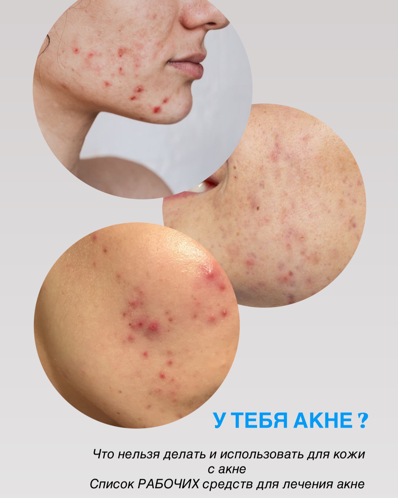 Косметолог Facebook ad: ПРЕПАРАТЫ ДЛЯ ЛЕЧЕНИЯ АКНЕ