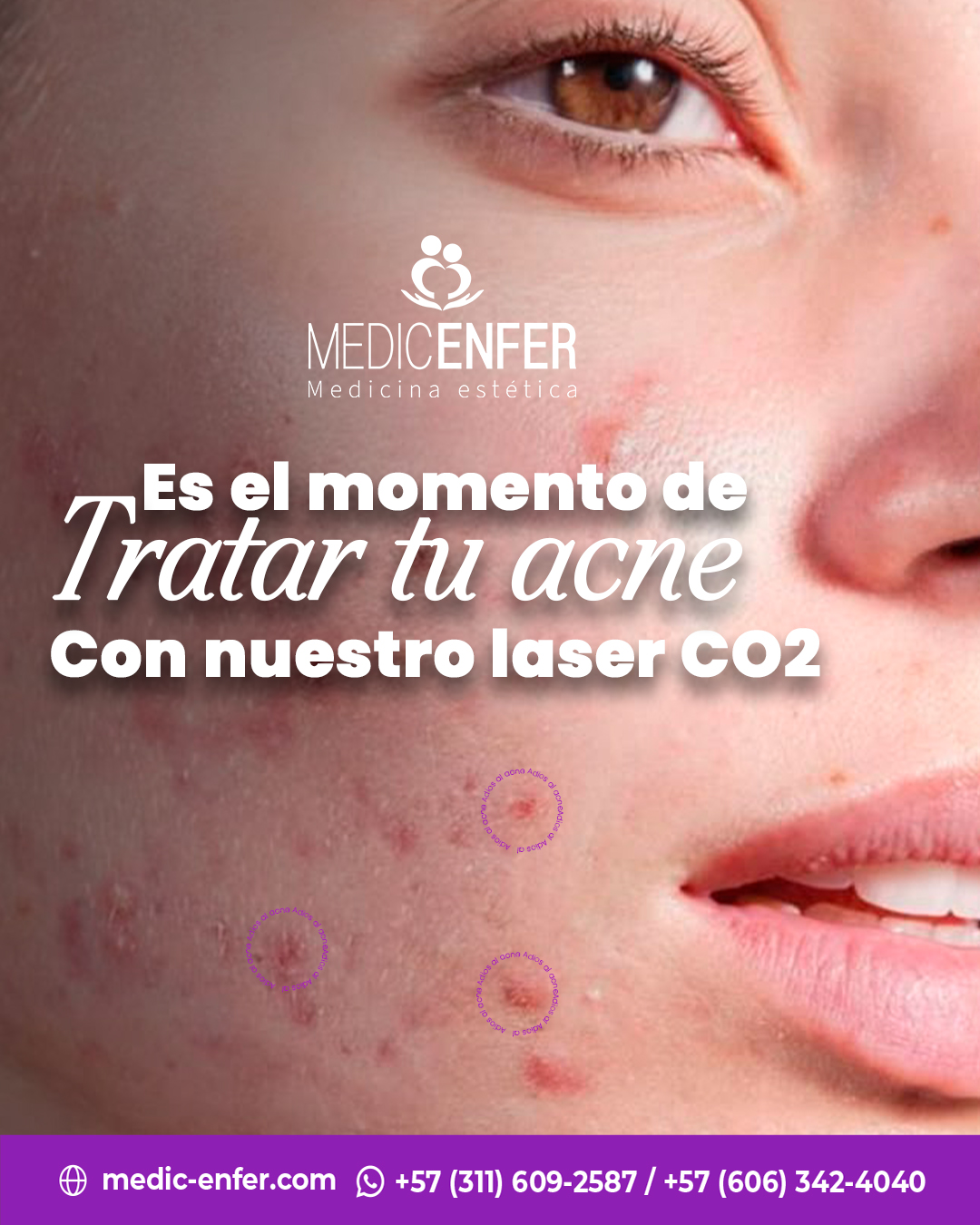 Medic Enfer Estética Facebook ad: El acné no es solo una etapa y…