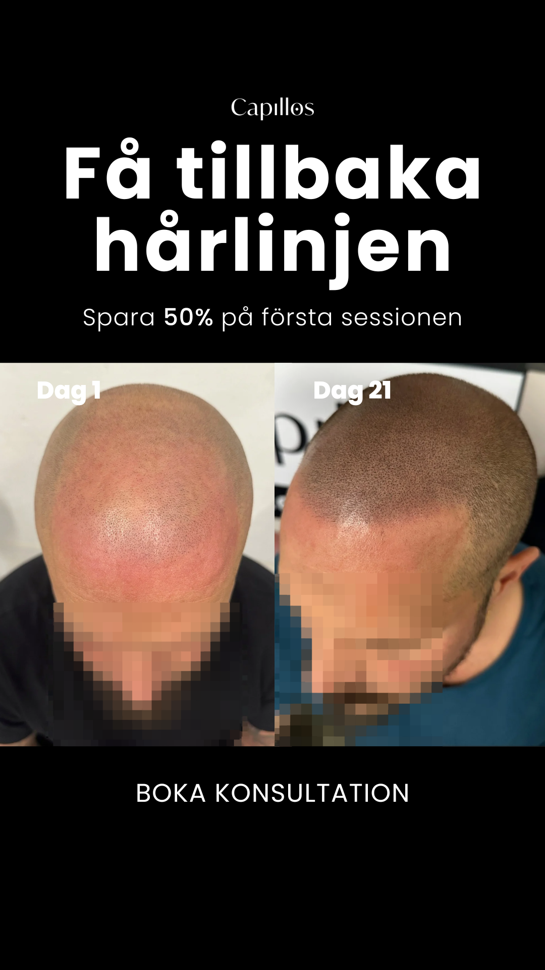 Scalp Micropigmentation Capillos Facebook ad from Mar 2, 2026