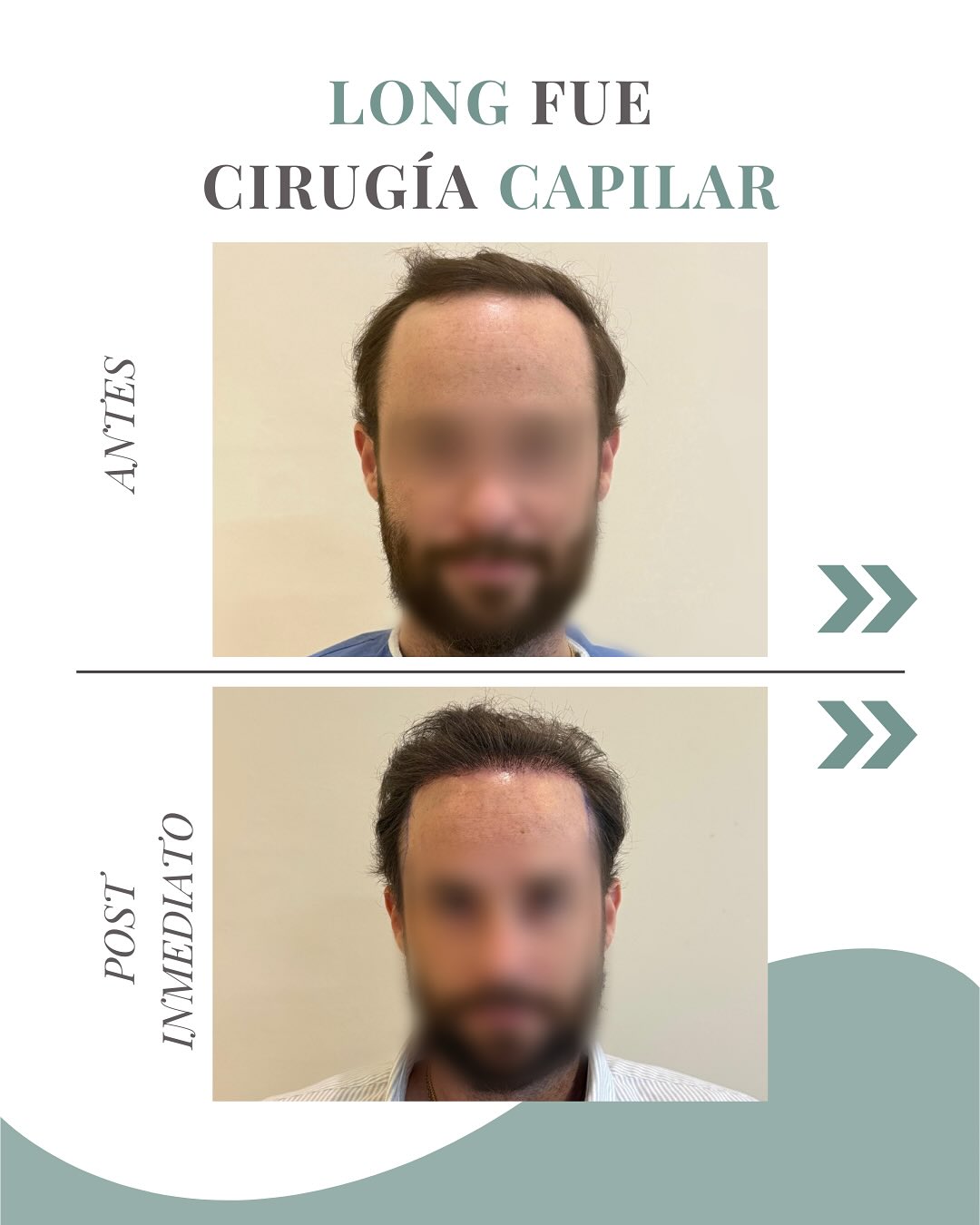 dr_santiago_boga Facebook ad: Cirugía Capilar: Tecnica LONG FUE