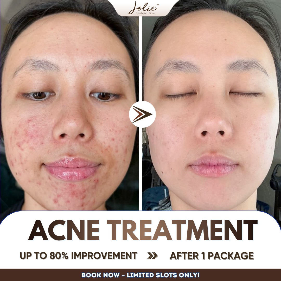 Jolie Acne & Scar Facebook ad: Acne Doesn’t Choose Anyone, And the Right Care…